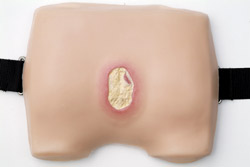 Model 4
Stage III:
Wound to subcutaneous tissue. A pocket may be formed